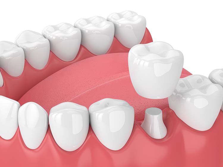 Bite Correction  Dental Beauty - Premier Dental Office in